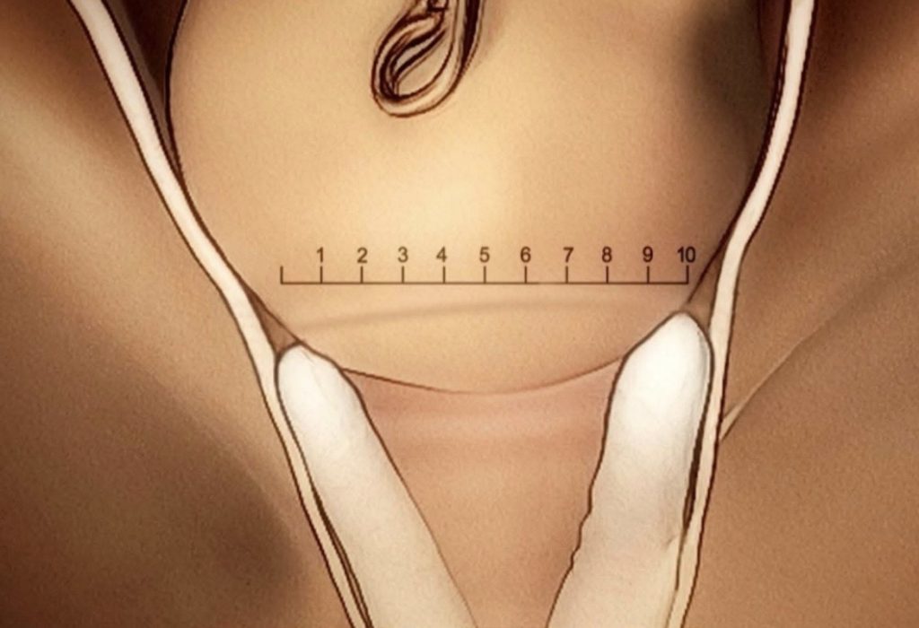 Dilatación en el trabajo de parto no lineal