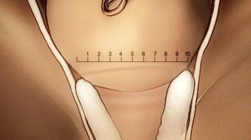 Dilatación en el trabajo de parto no lineal